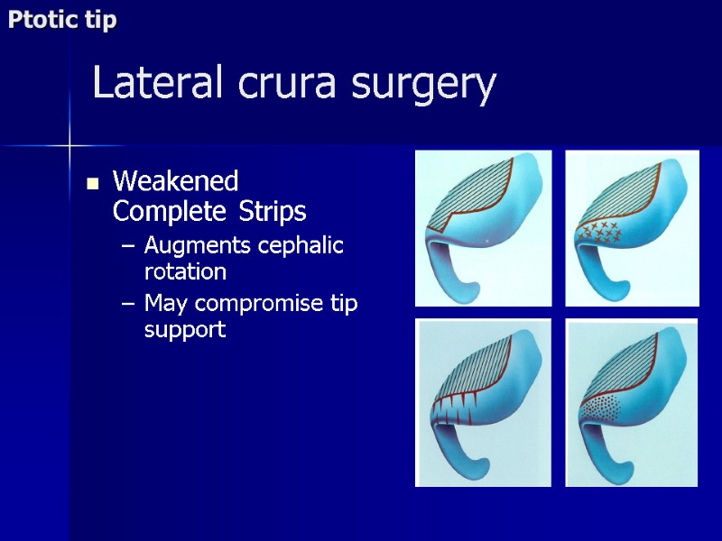 Lateral crura surgery Weakened Complete Strips Augments cephalic rotation May compromise tip support Ptotic